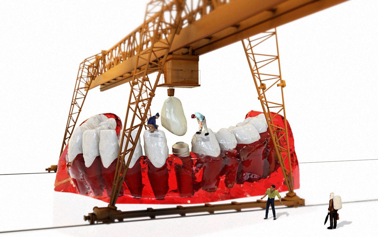 청주 임플란트 가격